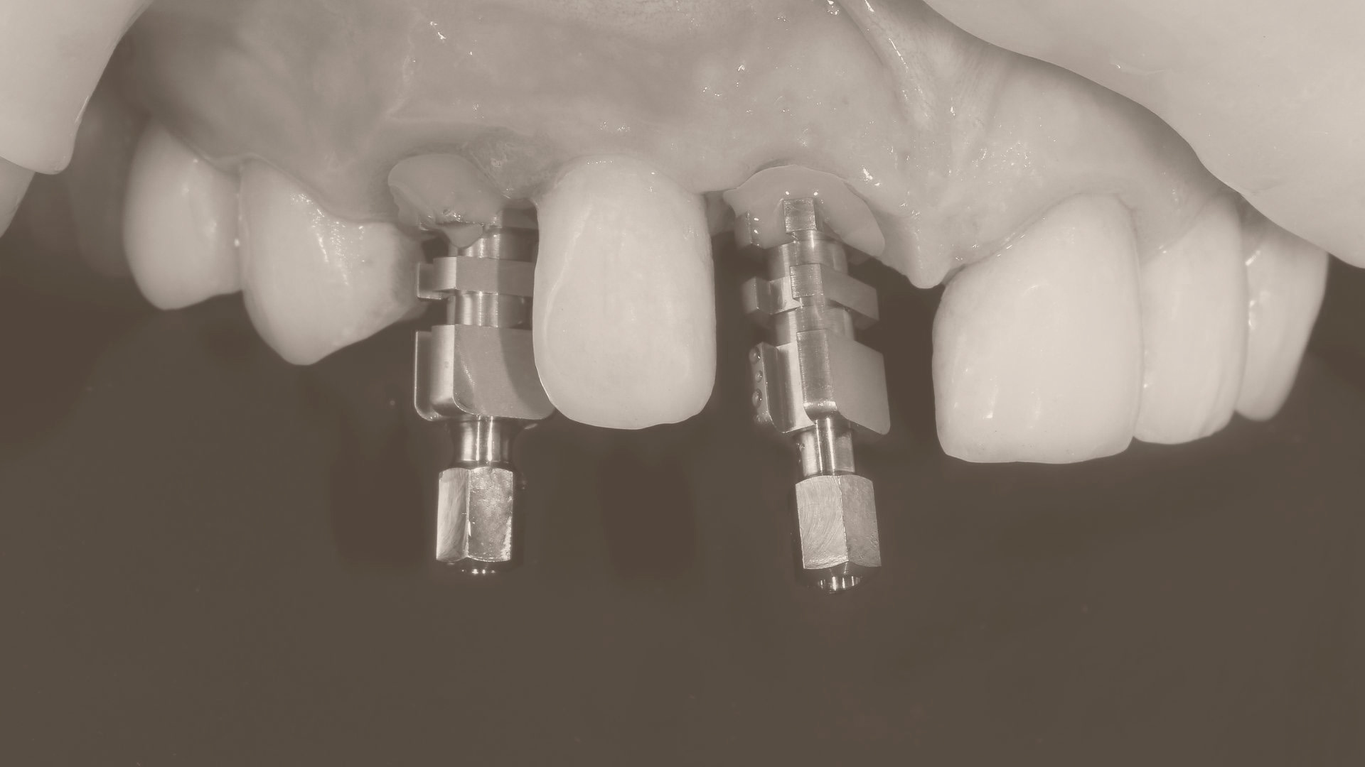 AudioBlog,musculatura facial