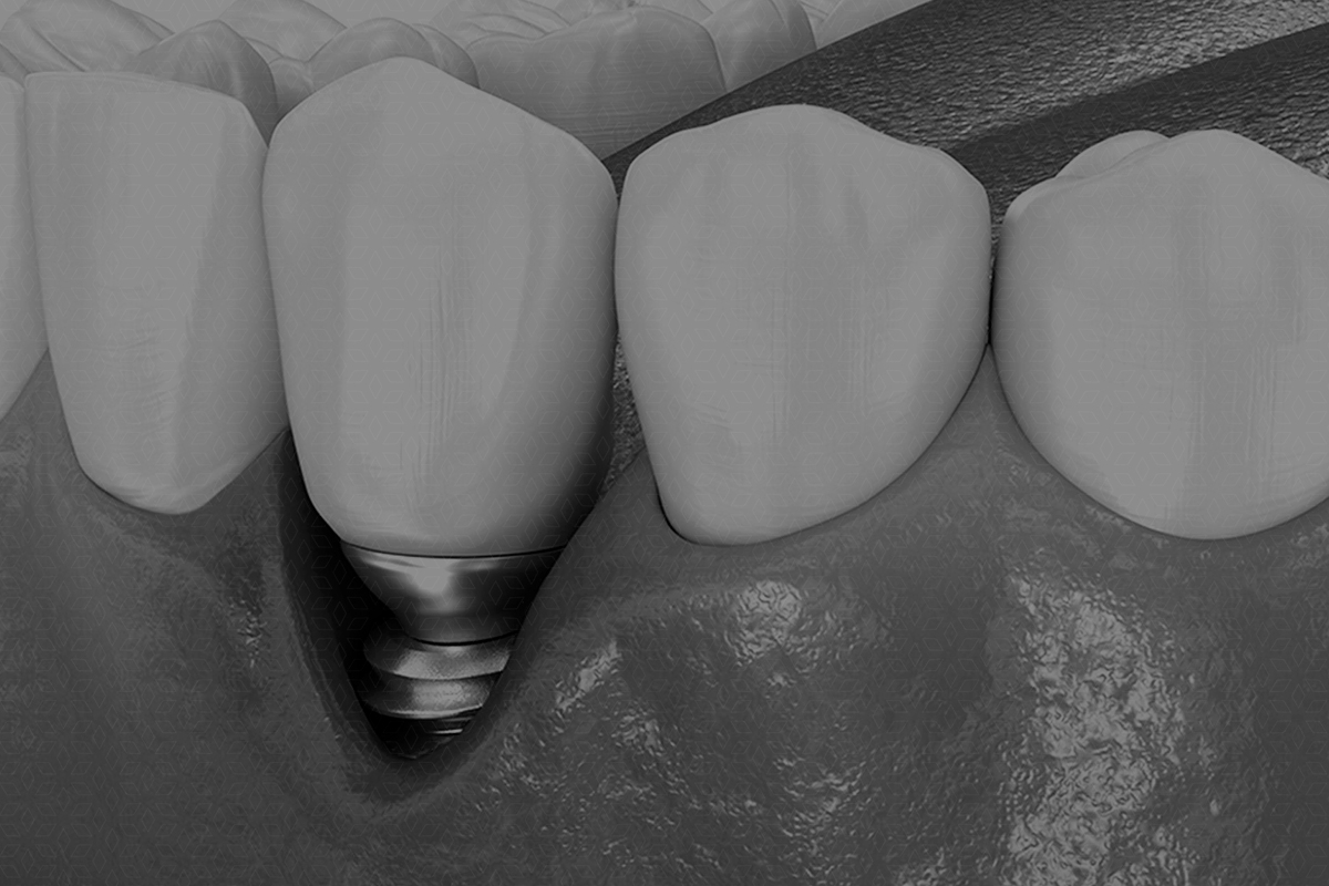 Estética dental,Elche,El Altet,Esther Sánchez,Dentales